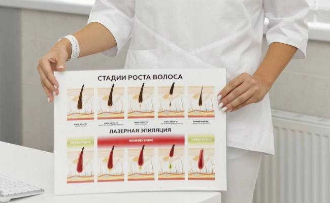 Лазерная эпиляция